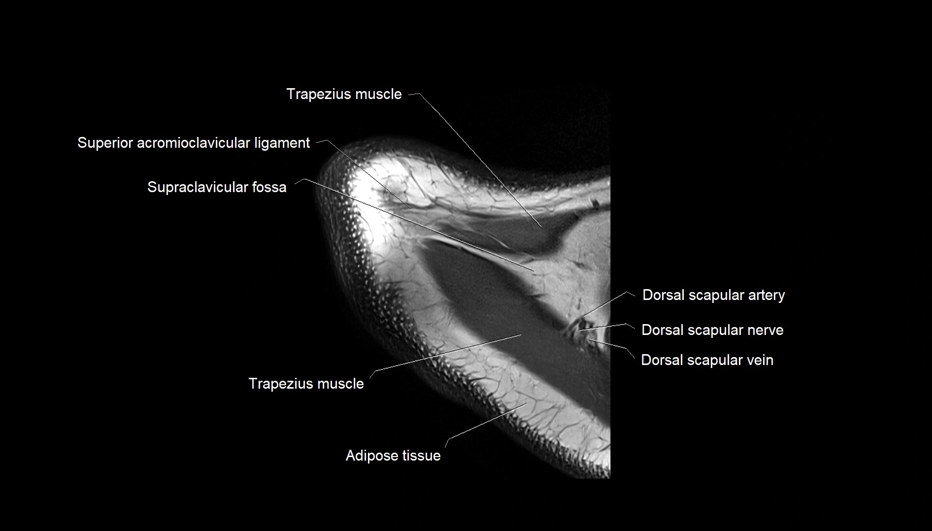 Shoulder cross sectional anatomy MRI 3T axial image 3.webp
